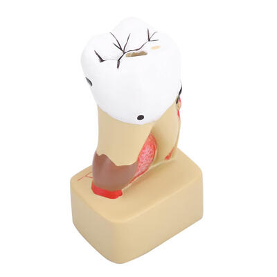 Greensen 1pc Dental Comprehensive Pathological Disease Caries Study Teaching Tooth Model Dental Model Tooth Education Model
Greensen 1pc Dental Comprehensive Pathological Disease Caries Study Teaching Tooth Model Dental Model Tooth Education Model