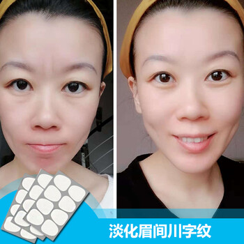 眉間皺紋