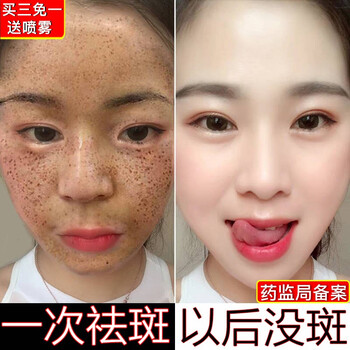 什么,哪個(gè),品牌,祛斑,祛斑,牌子