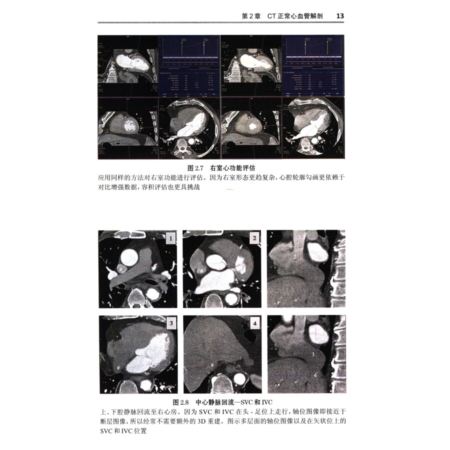 心脏ct一点通 心血管多层螺旋ct入门(第2版)