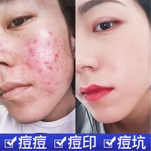 專用,專用,微針,微針,怎么樣