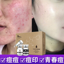 祛痘正品洗面奶