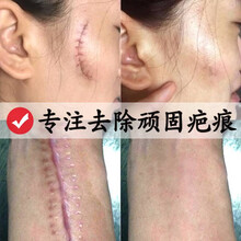 去疤痕膏手術(shù)傷疤