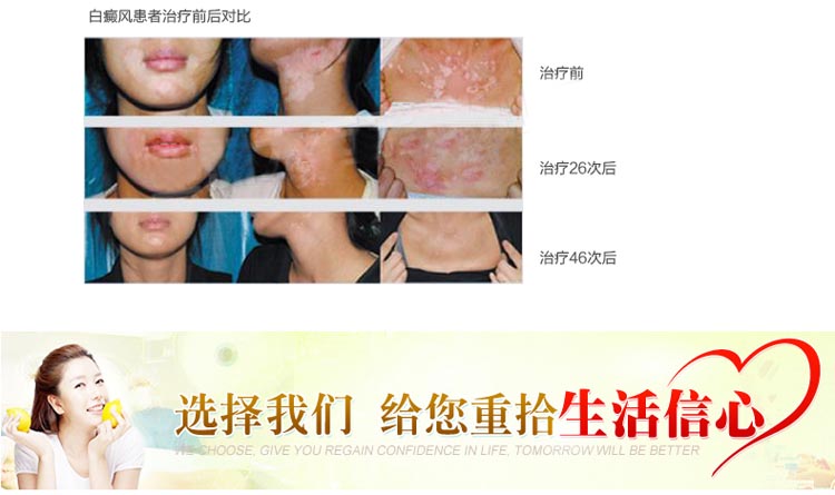 热销 科诺白癜风银屑病紫外线光疗仪KN-4003