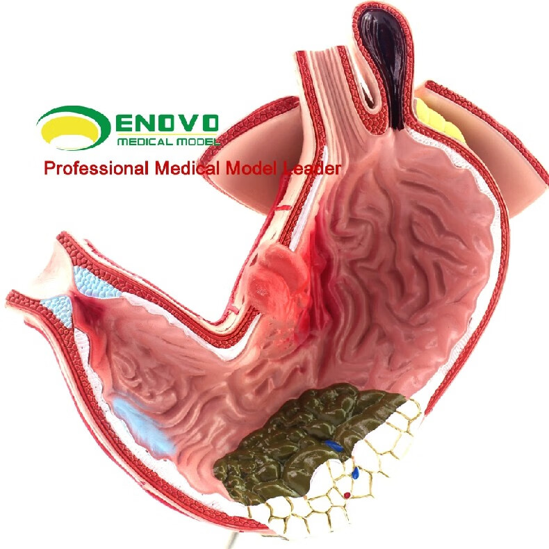 enovo颐诺医学胃部疾病演示模型人体胃解剖消化系统模型消化科专科