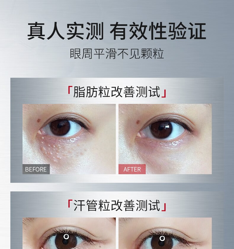 ning进口眼部精华液淡化脂肪汗管粒精华液紧致温和去油脂粒眼周女专用 【轻度脂肪粒适用】30ml