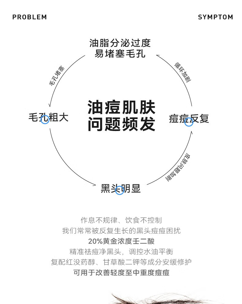 kismile壬二酸20%清肤焕颜霜凝胶祛痘印黑头淡化粉刺水润补水控油面30g 20%壬二酸30g