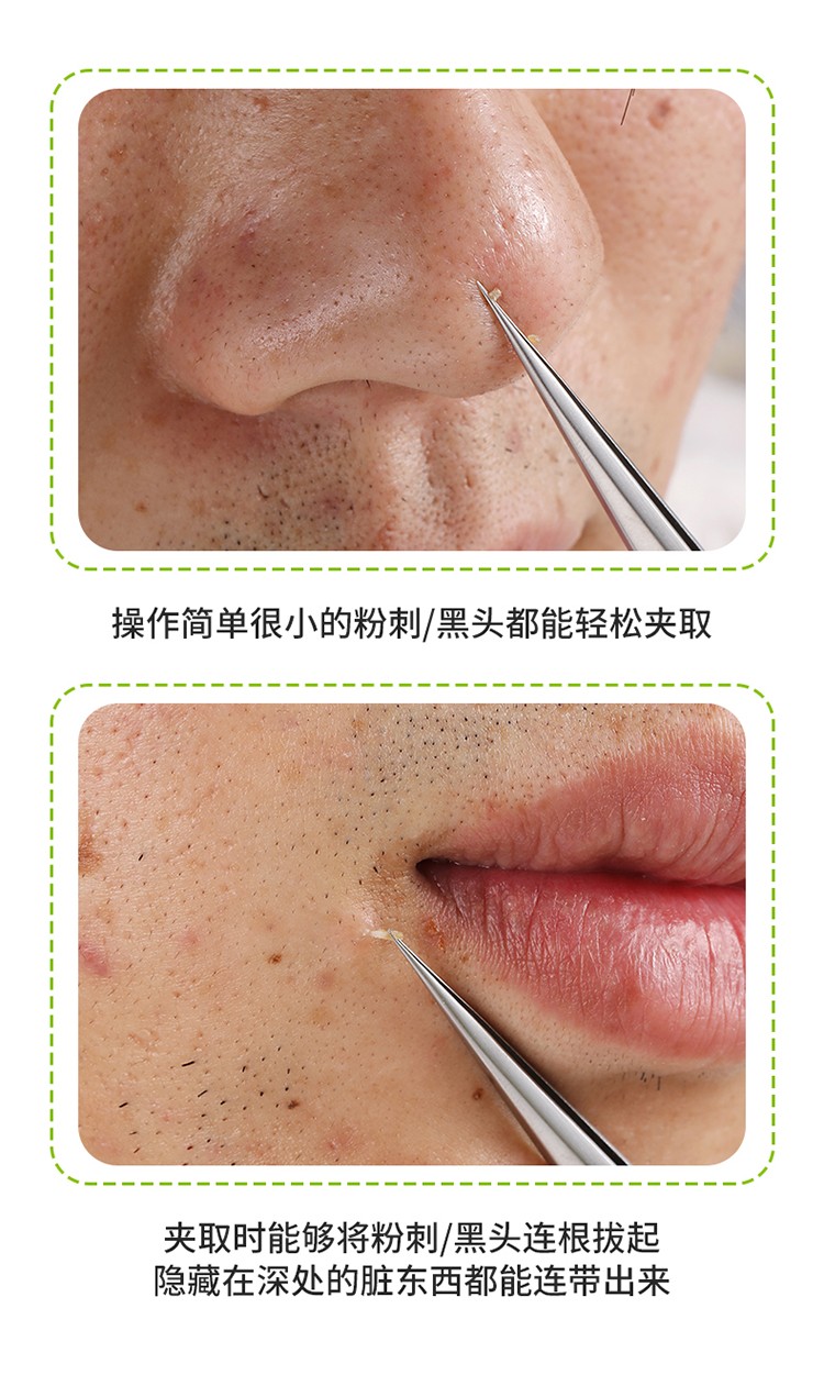 DITI 【超尖脂肪粒细胞夹】刮黑头夹子粉刺夹镊子美容院专用袪痘针