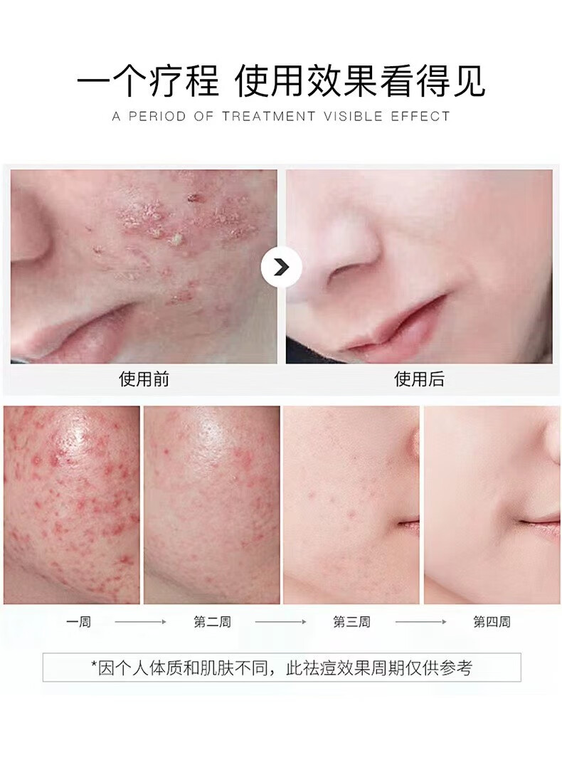 百颜世家壬二酸祛痘凝胶去痘坑痘印痘痕粉刺白头清爽补水高保湿祛痘膏 随机产品