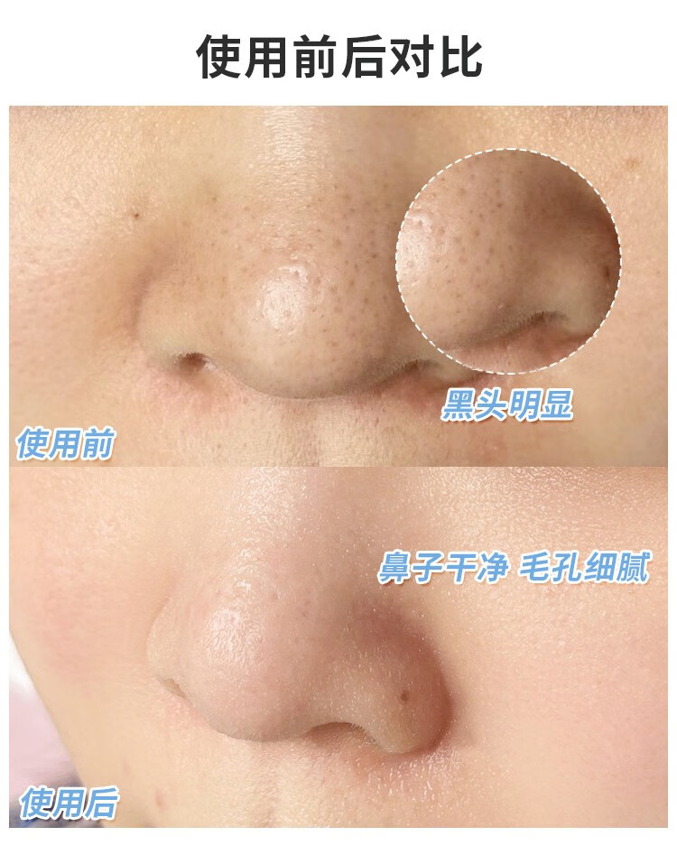 奕沃eiio净透去黑头鼻贴闭口粉刺清洁黑头收缩毛孔黑头贴男女学生 1盒10片