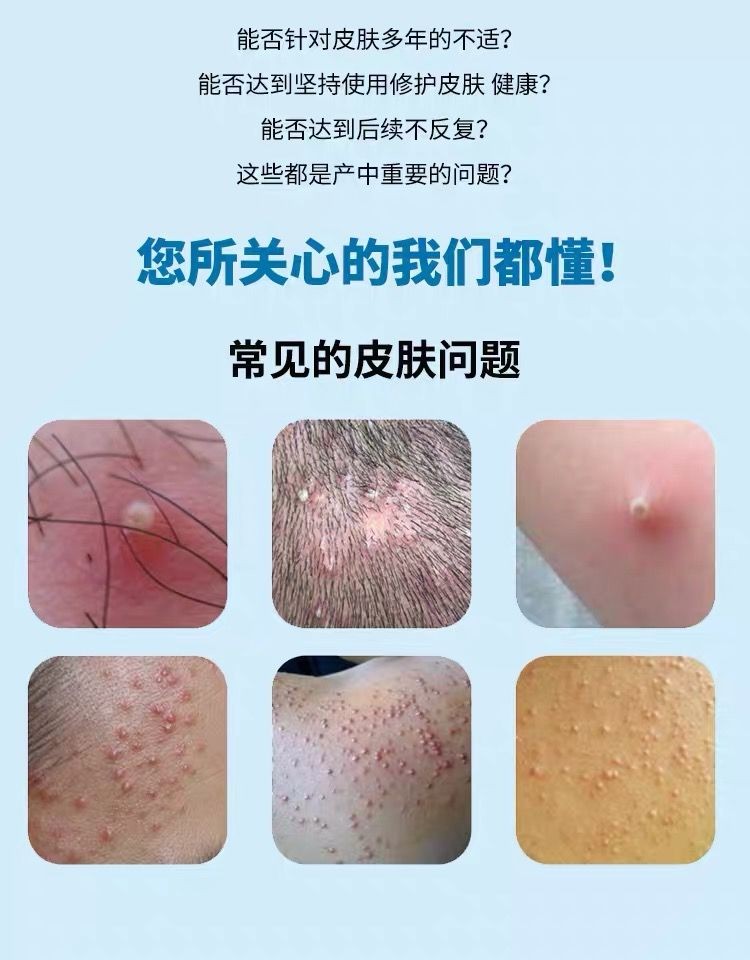 蛇盘疮带状泡疹后遗症神经痛汗泡疹奇方油剂型蛇缠腰盘疮冷敷凝胶