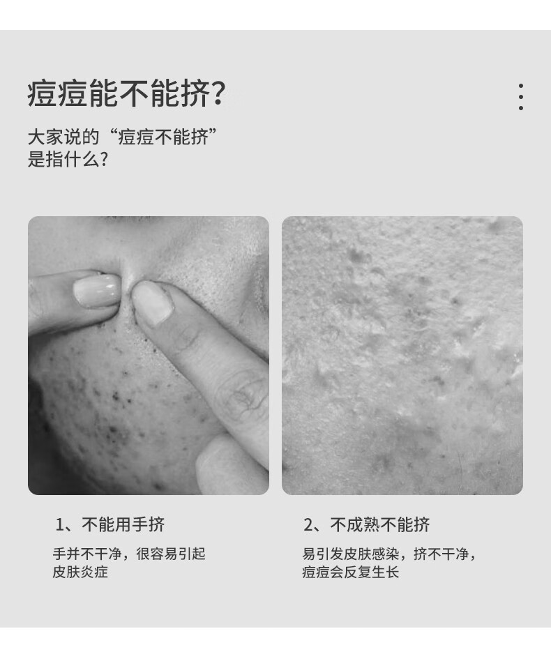 妙倩粉刺针套装去黑头针痘痘针暗疮针痘针美容针清痘针挑痘针排痘针挤痘痘镊子黑头夹刮清理去除工具 斜嘴夹+直嘴夹+弯钩夹