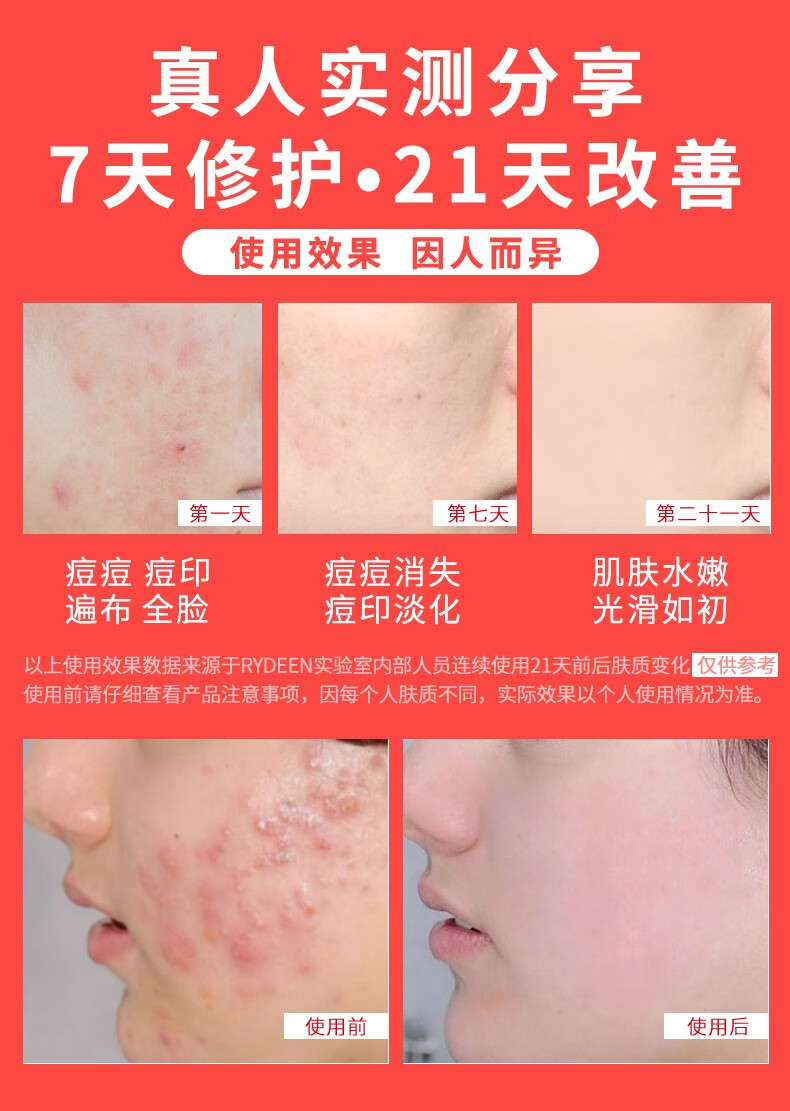RYDEEN水杨酸祛痘膏壬二酸清凝胶痘淡痘印抗痘男女清洁控油 2支壬二酸祛痘膏
