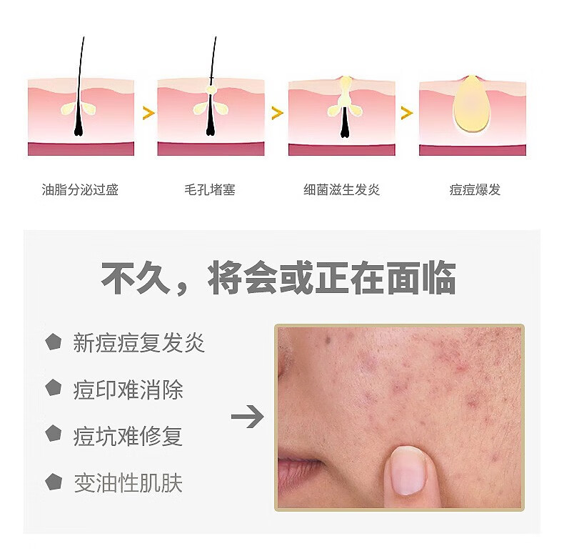 露伊薇丹虫草寡肽修护冻干粉套盒祛痘印修护肌底精华提拉紧致淡纹收缩毛孔