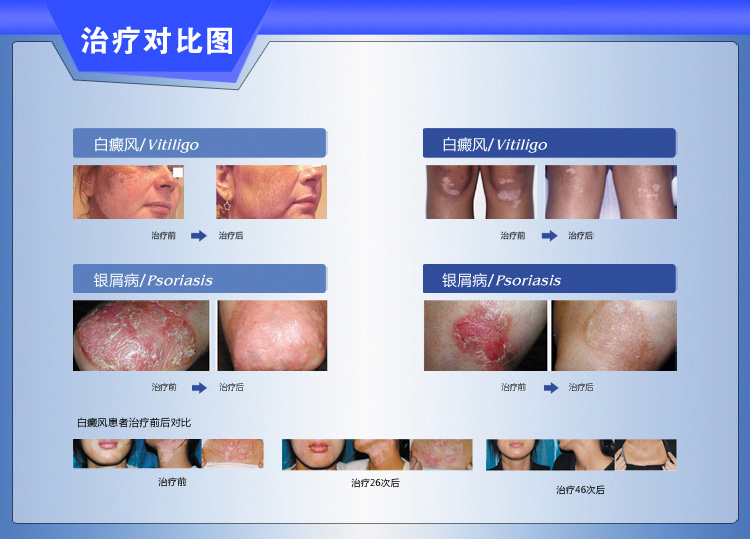 科诺 紫外线光疗仪 KN-4006A\/B 治疗白癜风银