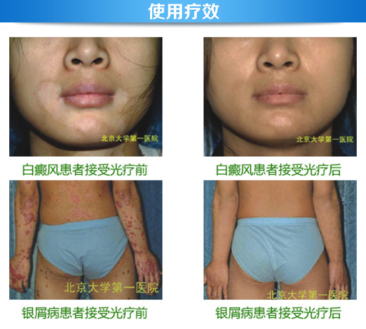 希格玛紫外线光疗仪SS-01(配护目镜) 希格玛紫