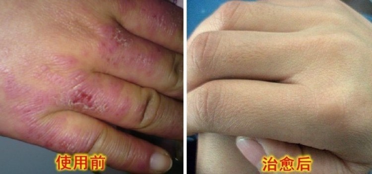 祛冻疮精油产品的成分分析