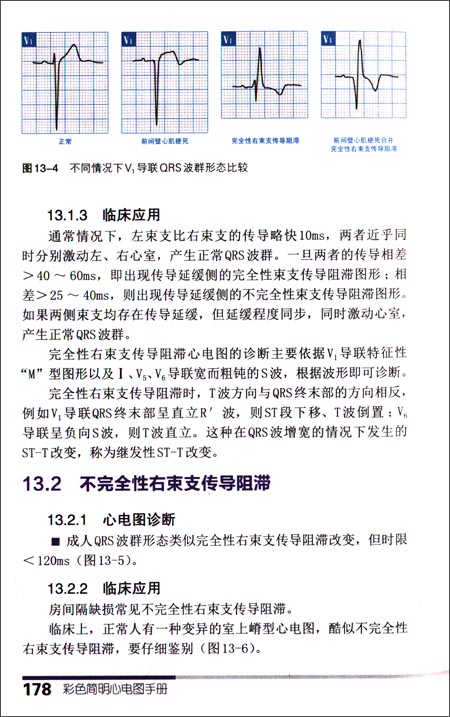 称为房性早搏伴差异性传导,最常见的是完全性右束支传导阻滞,因为右束