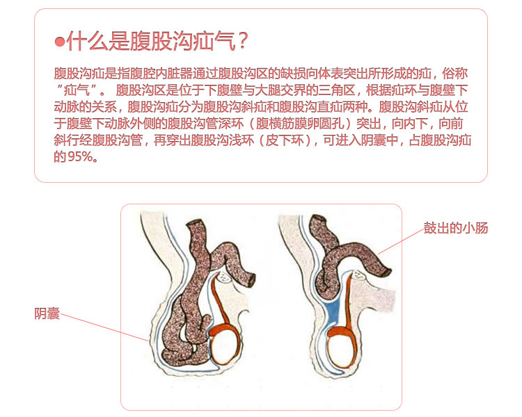 早康成人疝气带 腹股沟疝气治疗袋 超值2套装 医用家用 疝气治疗