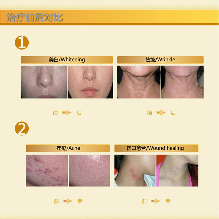 科诺LED光动力治疗仪KN-7000C 美白祛痘美容