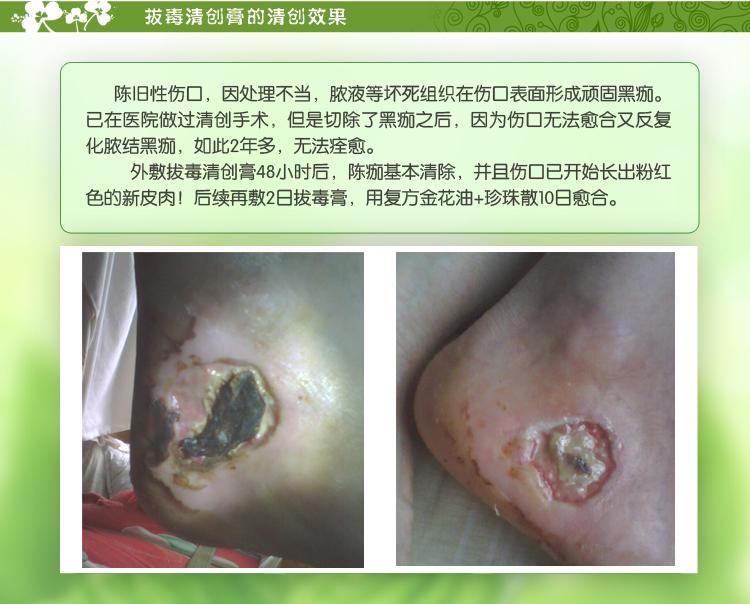 拔毒清创膏