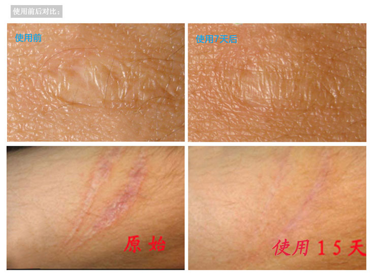 袭人复方淡斑祛疤精油 淡化去除黑色素沉淀 去