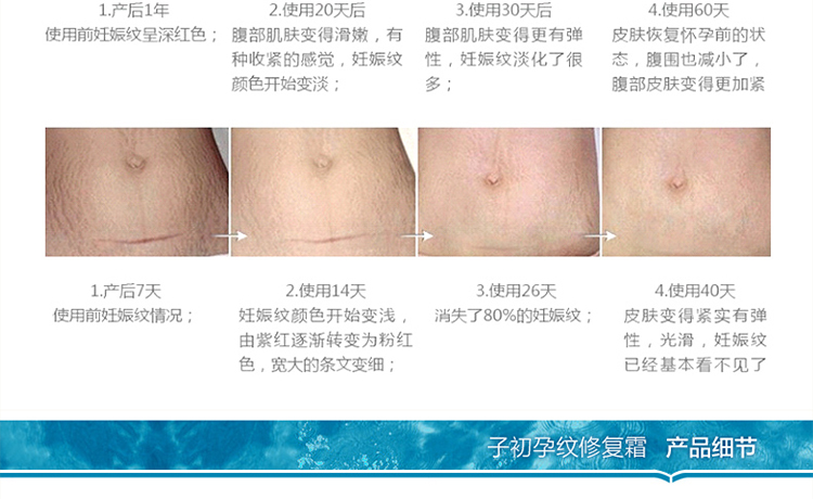 子初 孕妇妊娠纹产后消除产前预防专用 去除妊
