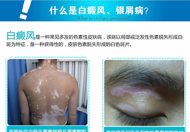 希格玛紫外线光疗仪SH-1智能型光疗机 白癜风