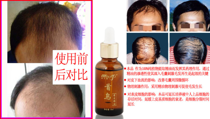 网比价】美乐雅首乌黑发复方精油30ml<em>根治少</em>
