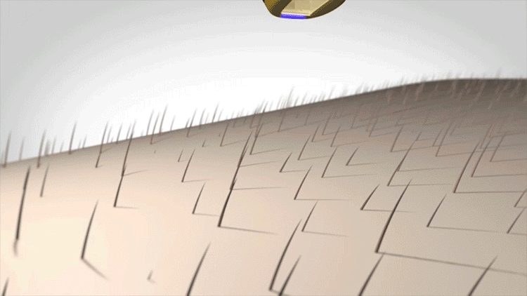 慕金(smoothskin) 脱毛仪器 脱毛机 家用激光腋下脱毛