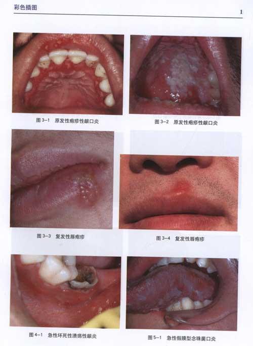 李秉琦实用口腔黏膜病学 医学 书籍