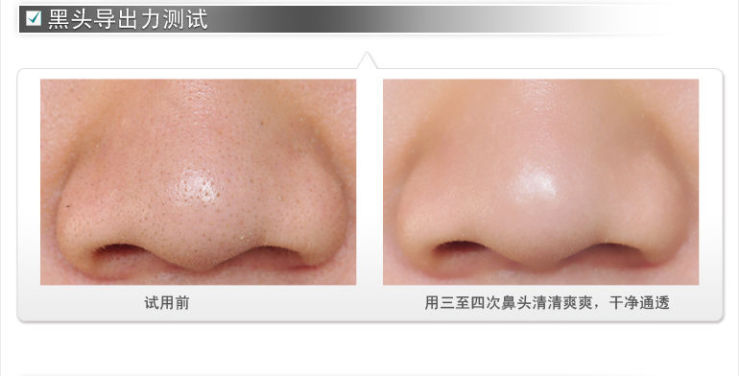 京东商城 瓷肌医生去黑头系列 清肌净颜黑头导