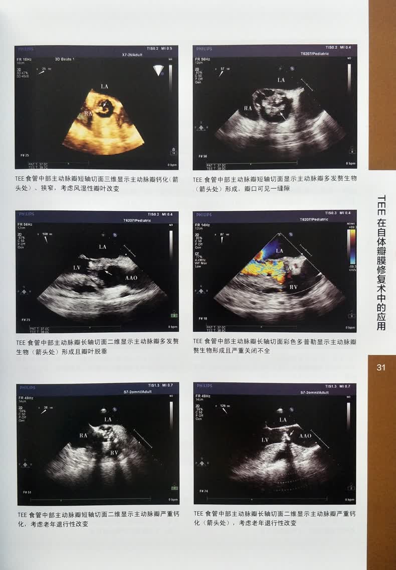 医学 致仕(zisiz) 术中经食管超声心动图人卫版 马小静 何亚峰 吴洋
