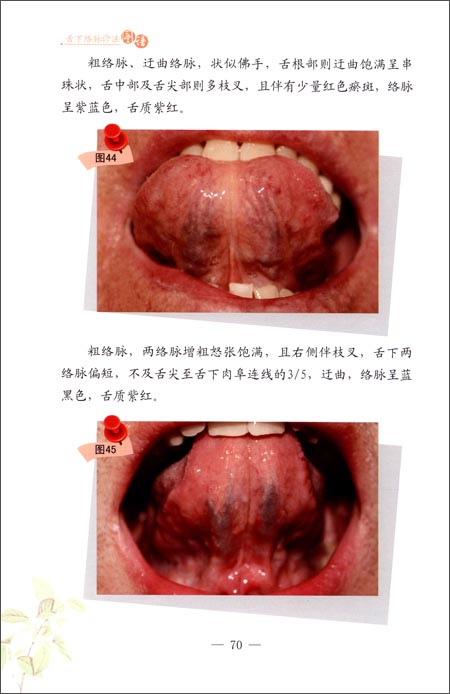 舌下络脉诊法图谱