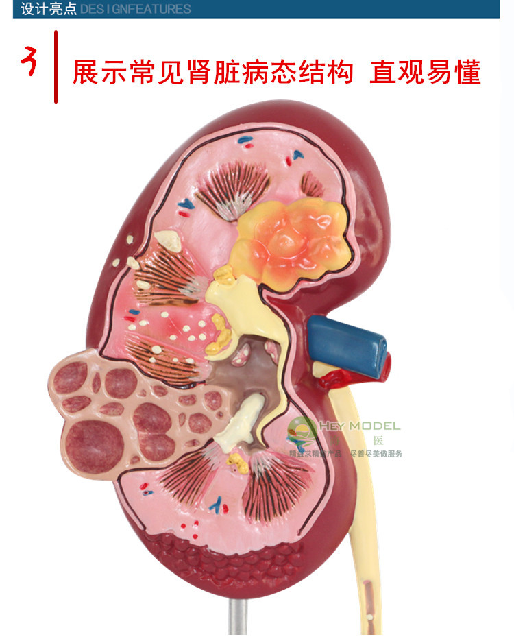 海医heymodel人体肾脏病变解剖模型肾结石泌尿内外科模型肾病演示泌尿