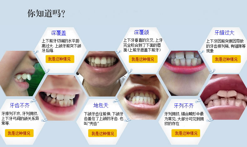 隐形矫正牙套 牙齿矫正器 矫正龅牙正畸保持器 夜间防