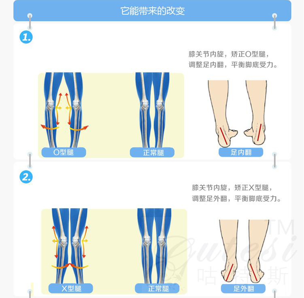 萨缤妮内外八字腿内外翻矫正鞋垫儿童成人xo型腿矫正垫男女士外侧磨鞋