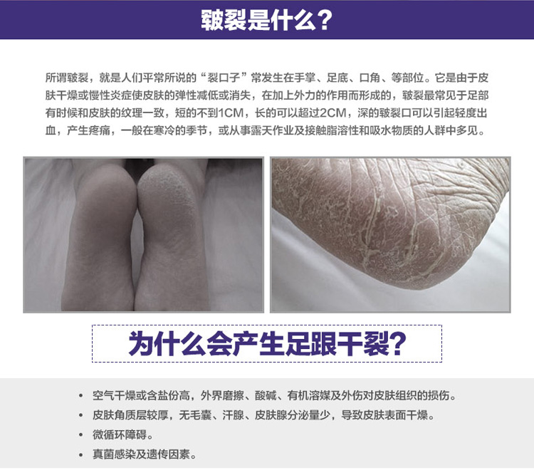 
                                        喜家家 硅胶足跟防裂套 后跟防脚裂 干裂保湿套 后跟型足跟足套 硅胶乳白色                