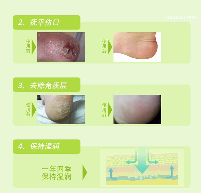 硅胶后跟保护套护脚 足跟痛男女防裂袜脚后跟干裂套 脚跟防裂袜套型XM1402