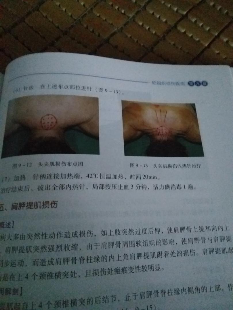 比新华书店便宜多了,又是正版,上面很多东西值得好好摸索,有一个问题就是现在的人娇气,针灸扎多了都在闹更不要说内热针了,上面好多病症都采用的是密集阵疗法--------------