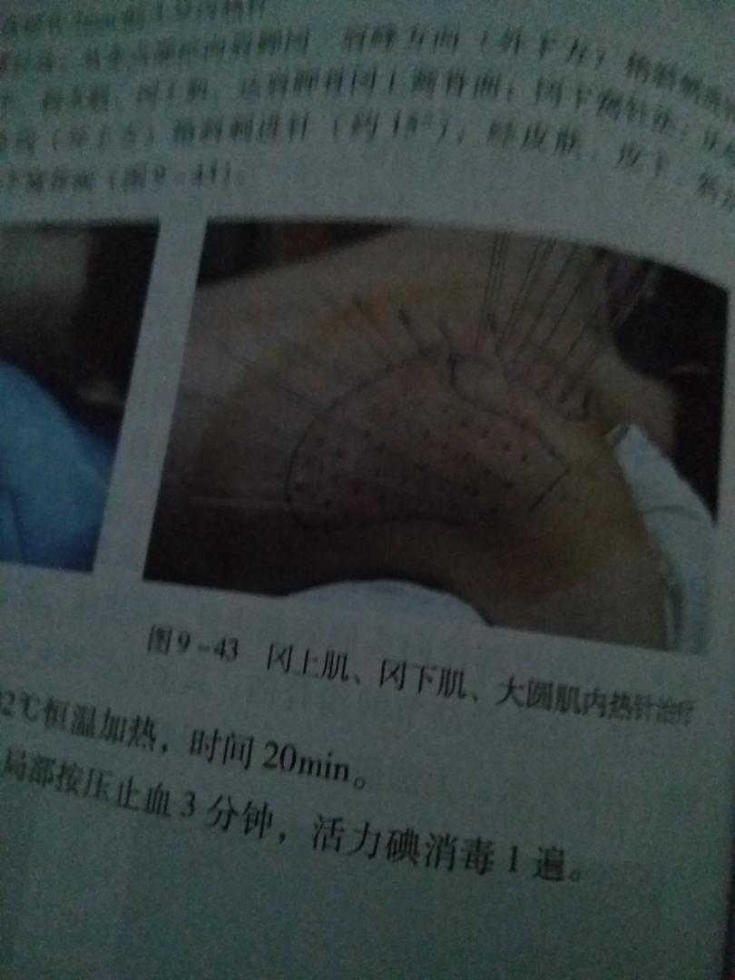 比新华书店便宜多了,又是正版,上面很多东西值得好好摸索,有一个问题就是现在的人娇气,针灸扎多了都在闹更不要说内热针了,上面好多病症都采用的是密集阵疗法--------------