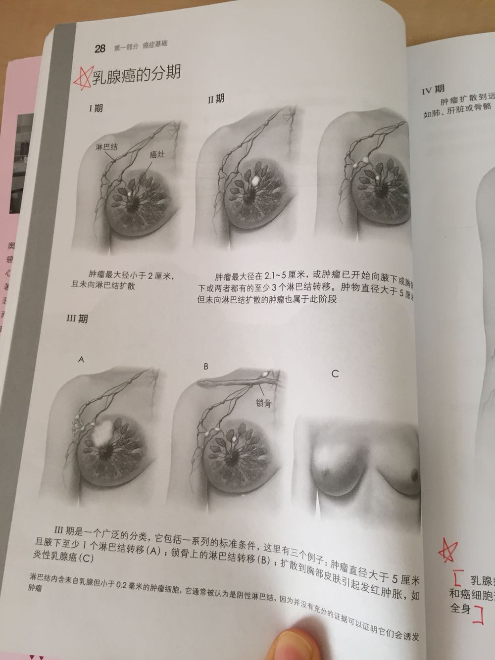这本书是美国最权威的癌症研究机构之一,Mayo Cancer Clinic撰写,由北京协和医院专家及团队翻译。这是妈妈生病后我看的第一本书,非常非常推荐!全书章节清晰完整,从预防-患病前期-乳腺癌分类-手术治疗方案-术后辅助治疗方案-复发及治疗-延伸的宫颈癌等疾病-心理安慰等方面,用最易懂的语言和图片,像患者及家属全面讲解了乳腺癌。了解了该如何选择手术,如何读懂病理报告单,每个指标分别说明了什么。对疾病的充分了解也会减少患者和家属的恐惧,能够更好的选择治疗方案,听从医生的建议。这个时候,在妈妈被病魔打击的特别脆弱的时候,我要做到临危不乱,我要成为她坚强的臂膀!这本书2017年1月第一次出版,所以我认为书中介绍的治疗方法,一定已经是全世界最前沿的方法了。让我放心的是,医院给出的治疗方案,和书中介绍的无异,也就说明妈妈接受的已经是最前沿和最有效的治疗了!