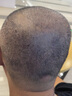 雍禾植發(fā) 剃發(fā)植發(fā)不限單位 大面積頭頂加密種植頭頂稀疏發(fā)縫大高額頭 剃發(fā)植發(fā)2000單位以上（含醫師費） 全國 曬單實(shí)拍圖