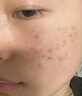 泊紫汀蘭祛痘膏祛痘淡化痘印消閉口修護痘痕痘坑去粉刺控油青春痘男女學生 曬單實拍圖