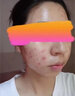 欖潤南京同仁堂祛痘膏控油祛痘印痘坑修復啫喱淡化紅腫疤改善粉刺痘肌 一盒【三盒一周期】拍3盒、6.6折 曬單實(shí)拍圖