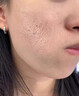 DR.AVIN【德國品牌】醫(yī)用痘坑修復(fù)凹洞填充再生長因子祛痘印淡化修復(fù)男BD 送醫(yī)用棉簽【買二送一】療程裝大部分用戶選擇 曬單實(shí)拍圖