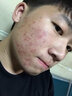同仁堂祛痘膏祛痘印修復淡化去痘痘和痘印痘坑青春痘粉刺閉口男女精華液 一盒裝【體驗裝】 曬單實(shí)拍圖