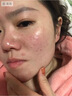 ning水楊酸祛痘面膜10片保濕補水去痘印修復痘坑收縮毛孔男女士 曬單實(shí)拍圖