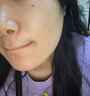 俏諾薇水楊酸祛痘膏青少年祛痘淡化痘印痘坑男女學(xué)生青春痘溫和不刺激 1支【體驗裝】*20ml 曬單實(shí)拍圖
