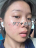 珂語祛痘膏苦參根草本植萃祛痘霜去痘痘印修護青少年青春痘面霜護膚品 【買1送1 到手2瓶裝】草本祛痘膏 曬單實拍圖